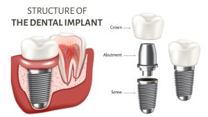dental implants cost in NY