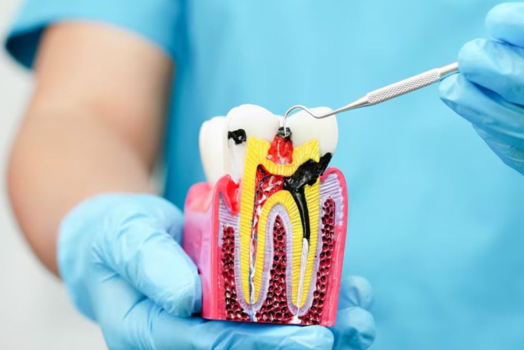 Tooth Decay Treatment in Kingston