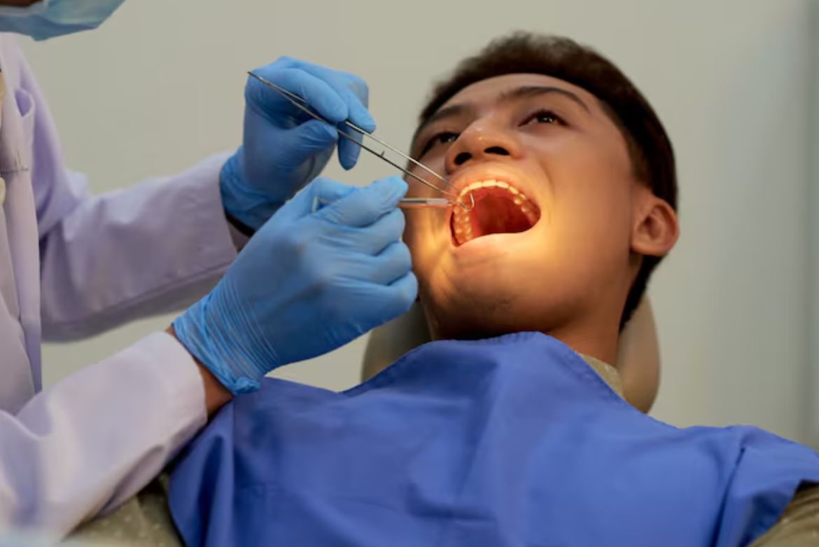 Root Canals Treatments in Kingston