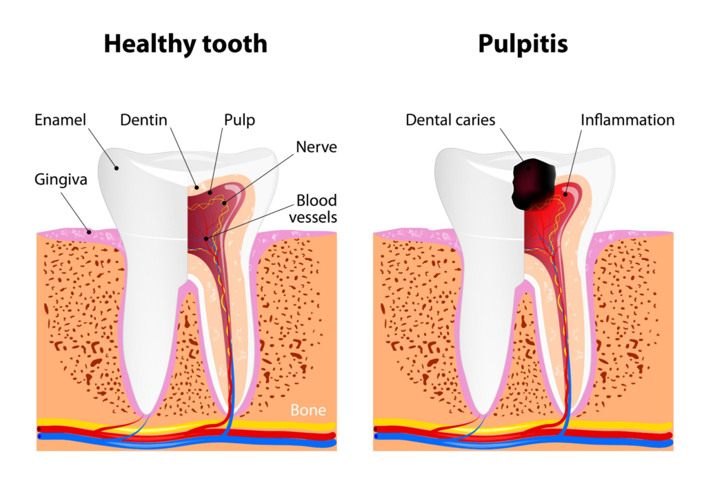 Why Does Toothache Hurt More